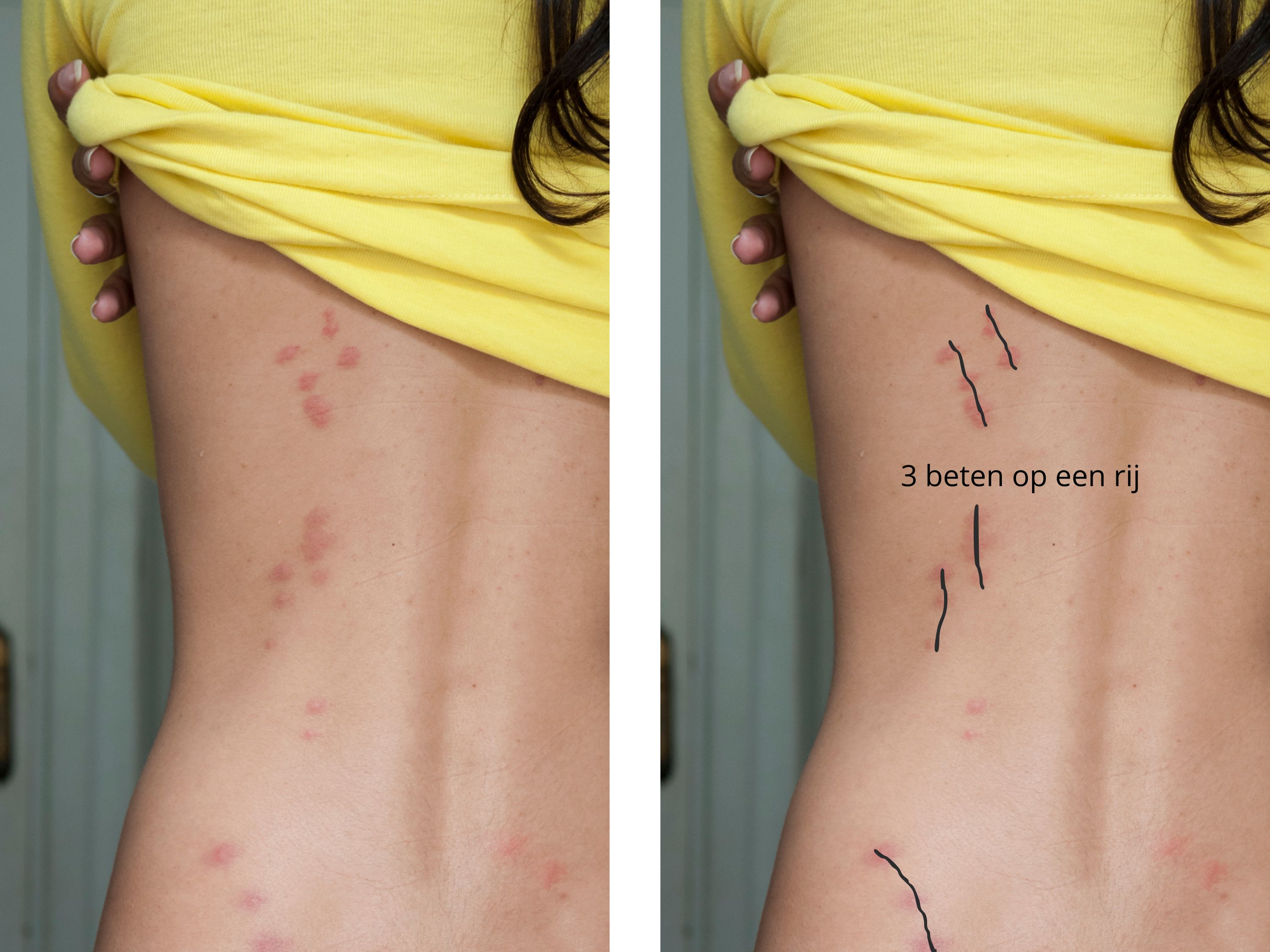 Bedwantsbeten herkennen